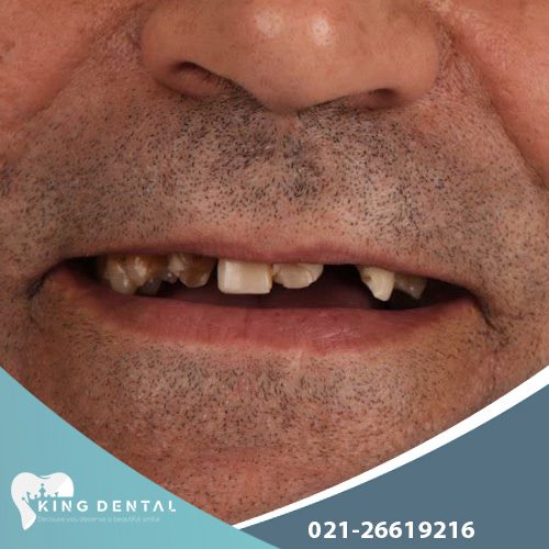 روکش دندان در سعادت اباد