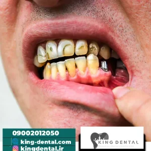 عوارض ایمپلنت دندان کدام است؟