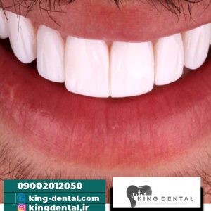 حکم لمینت از نظر اسلام