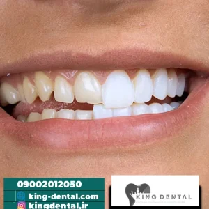 کامپوزیت سوئیسی