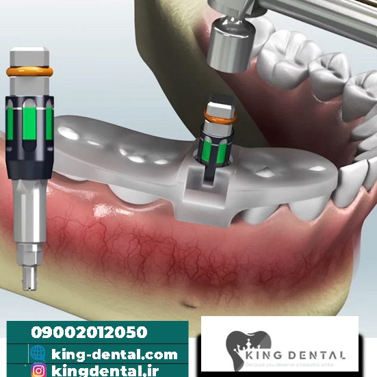 ایمپلنت دیجیتال