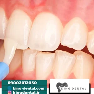 فلوراید دهان چیست؟