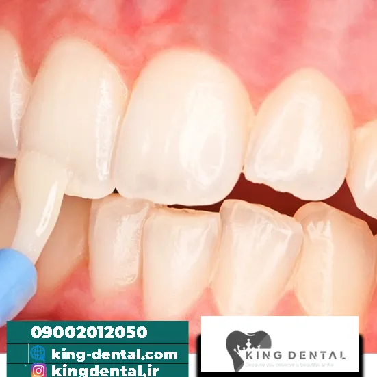 فلوراید دهان چیست؟