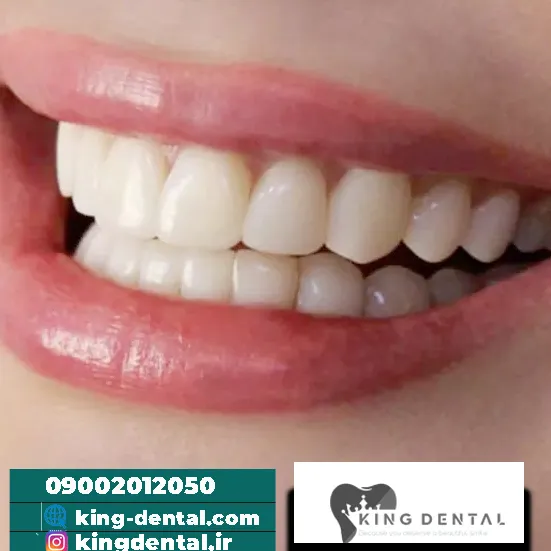 فواید لمینت دندان چیست؟