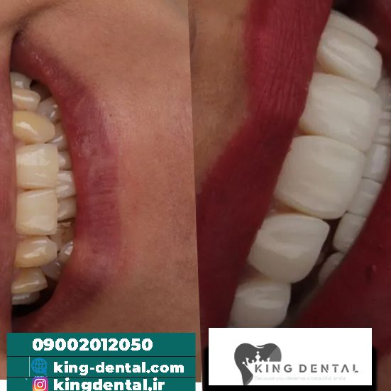 مراقبت های بعد و قبل کامپوزیت