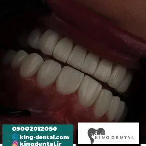 کامپوزیت دندان در زعفرانیه