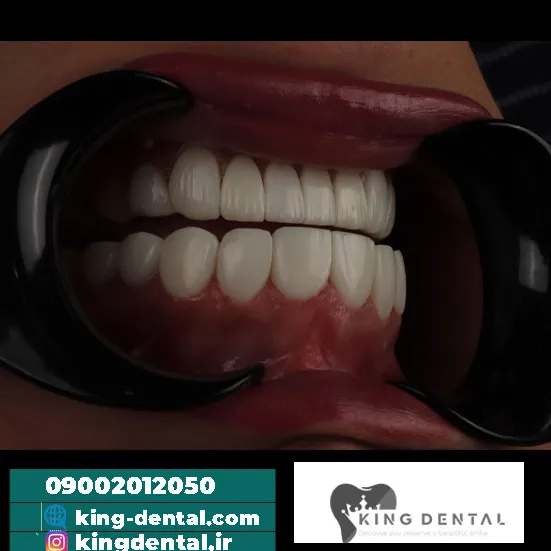 خدمات کامپوزیت دندان در زعفرانیه
