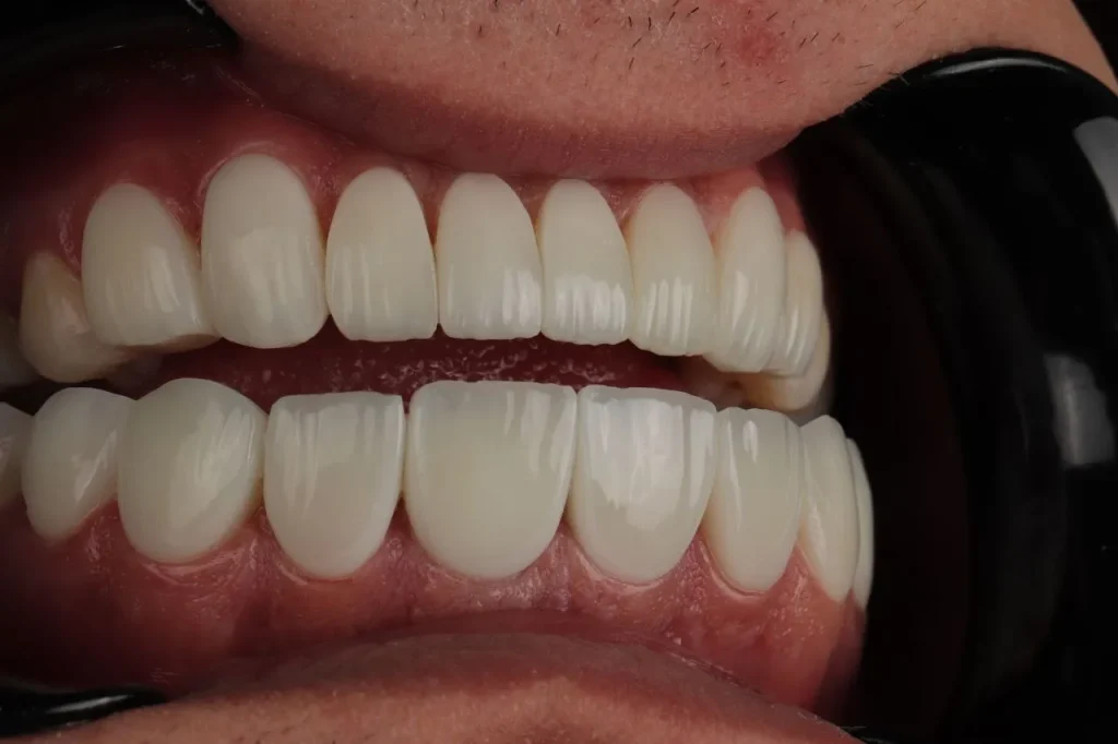 کامپوزیت لیرینگ