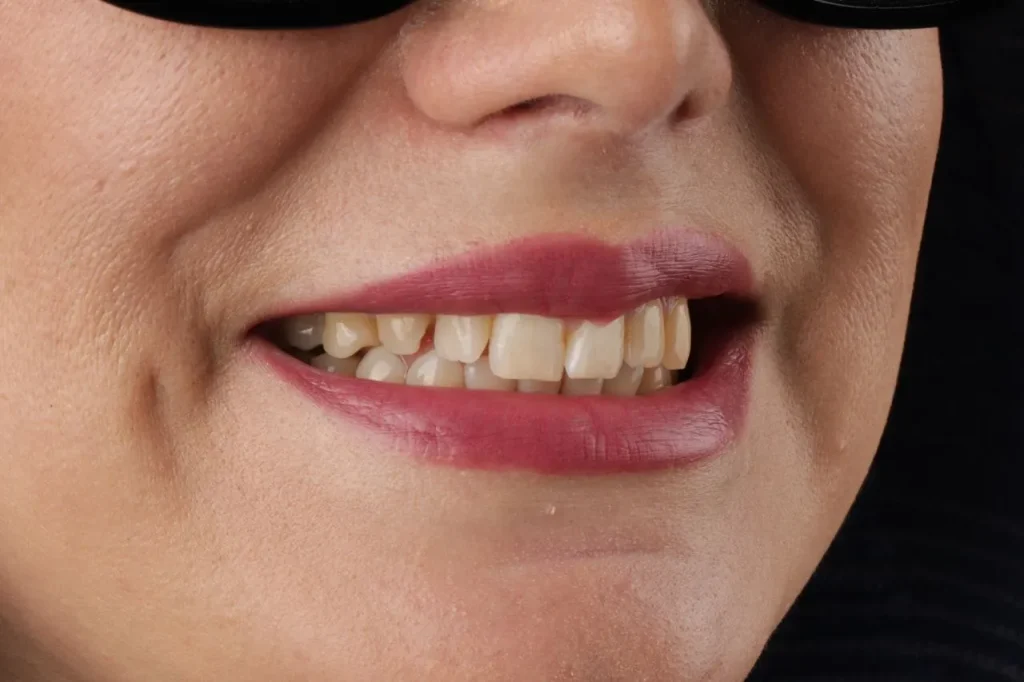 قبل از عمل کامپوزیت فیکسچر