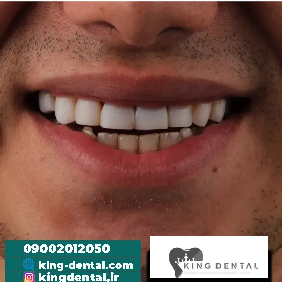 سوالات افراد در مورد کامپوزیت دندان