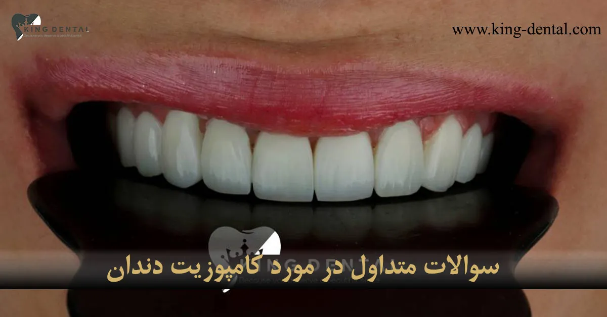 سوالات متداول در مورد کامپوزیت دندان