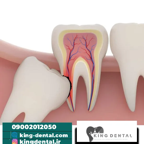 عوارض نکشیدن دندان عقل 