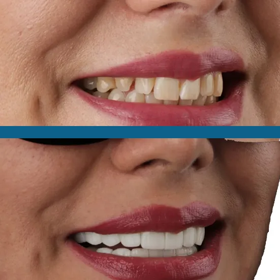 عکس های قبل و بعد کامپوزیت دندان