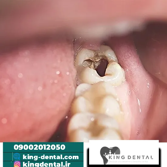 عوارض نکشیدن دندان عقل