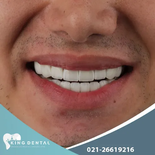 کامپوزیت در تهرانپارس