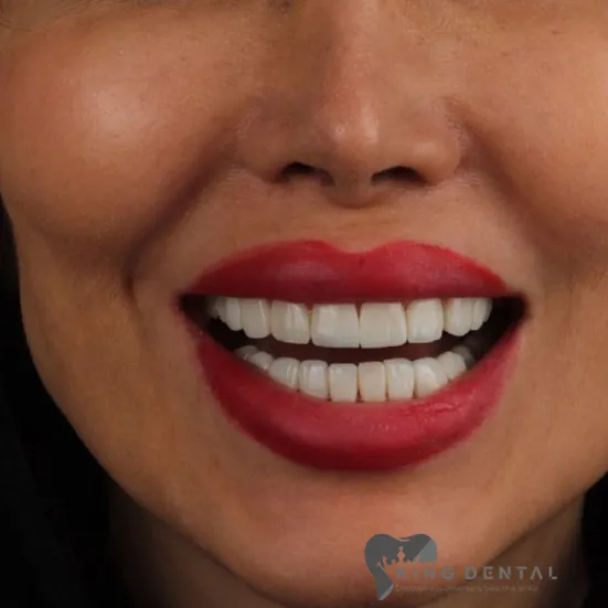 کامپوزیت دندان در شهرآرا تهران 