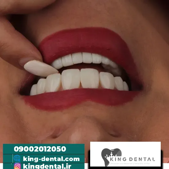 کامپوزیت دندان در میدان انقلاب