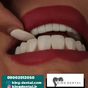 کامپوزیت دندان در تهرانپارس