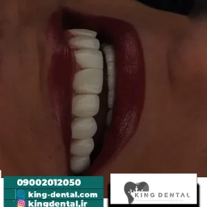کامپوزیت دندان در الهیه