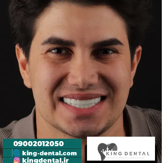کامپوزیت دندان با تکنیک لیرینگ در تهران