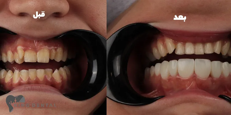 کامپوزیت دندان در باقرشهر