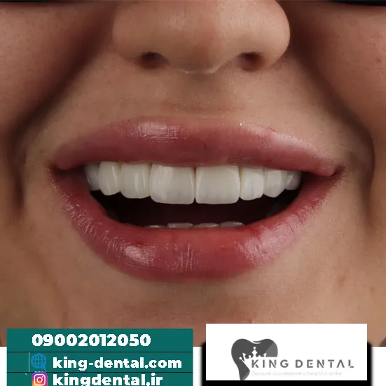 کامپوزیت دندان در باقرشهر تهران