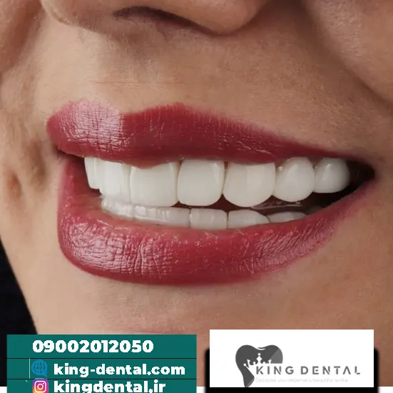 کامپوزیت دندان در فرشته تهران