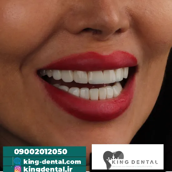 کامپوزیت دندان در شهرآرا تهران