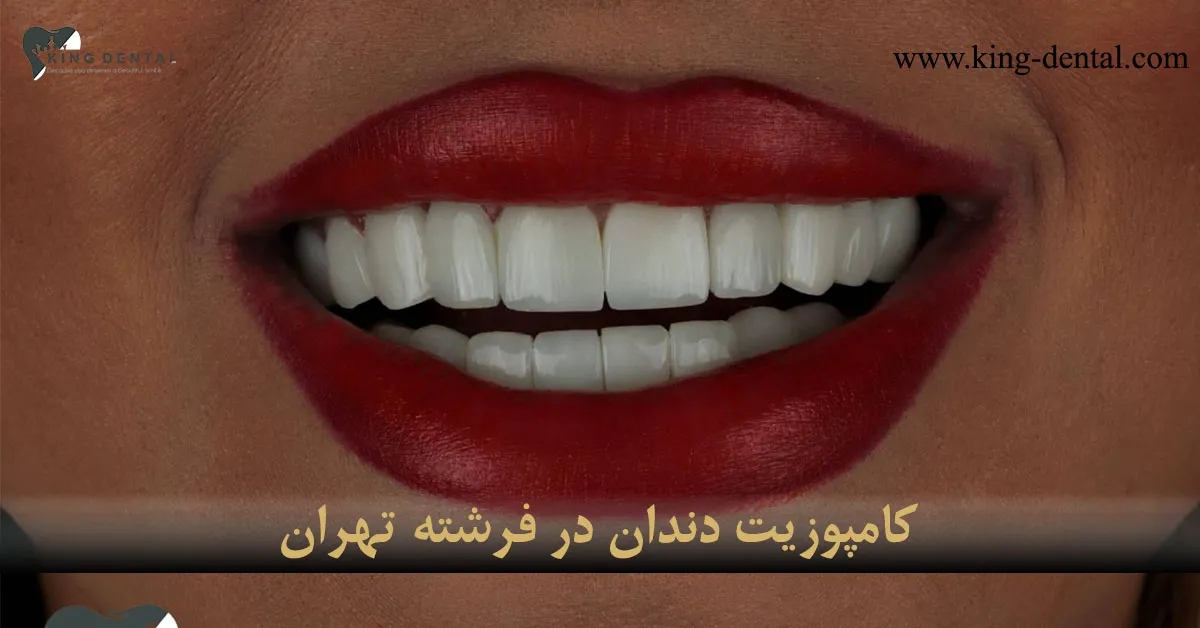 کامپوزیت دندان در فرشته تهران
