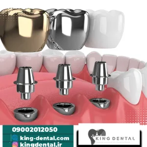 ایمپلنت دندان در تجریش تهران