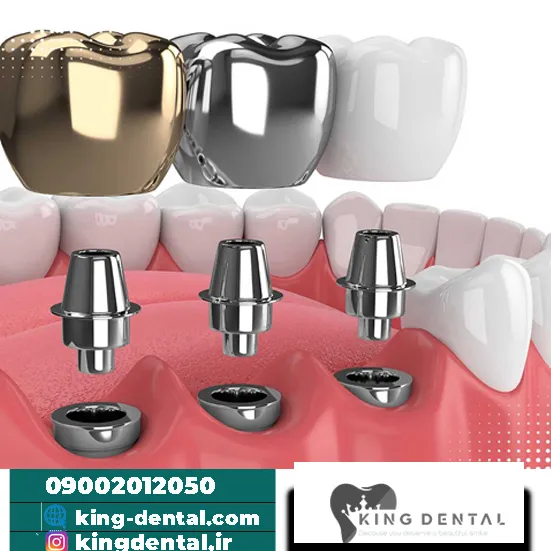 ایمپلنت دندان در تجریش تهران