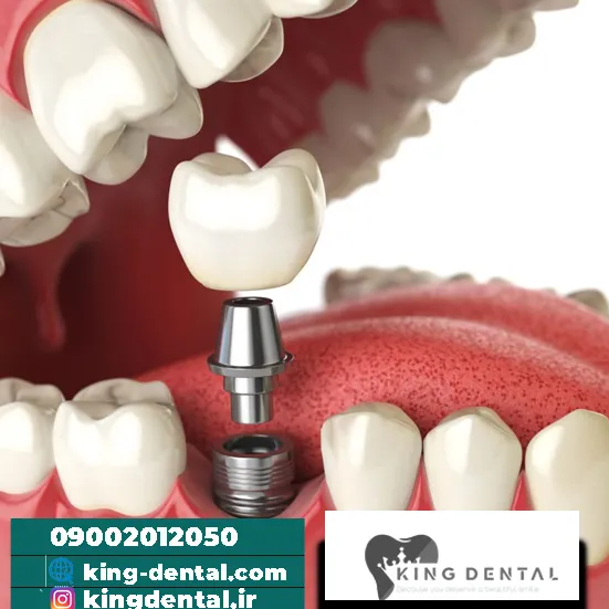ایمپلنت دندان در فرمانیه تهران
