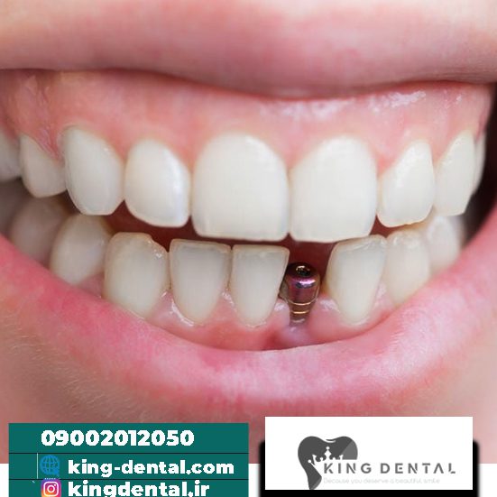 ایمپلنت دندان در ونک