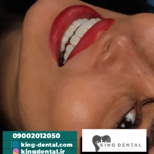 کامپوزیت دندان در ونک تهران