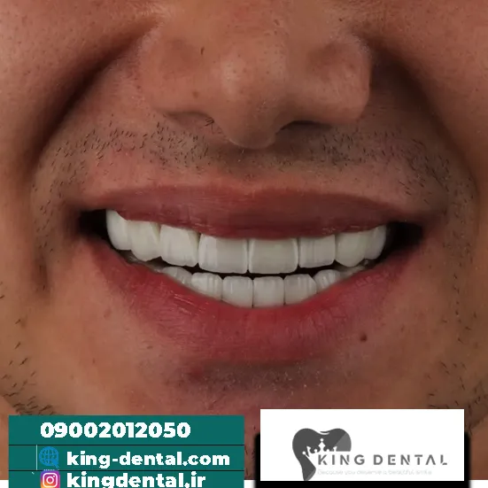 کامپوزیت دندان در مرزداران تهران