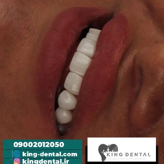 کامپوزیت (14)