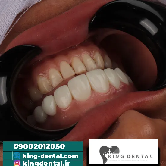 کامپوزیت (15)