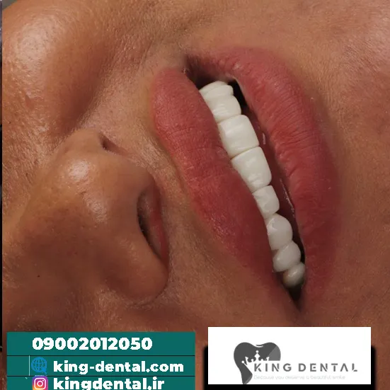 کامپوزیت (17)