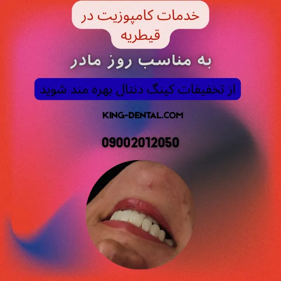 کامپوزیت دندان در قیطریه تهران