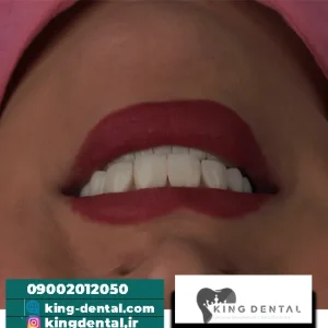 کامپوزیت دندان در ظفر تهران